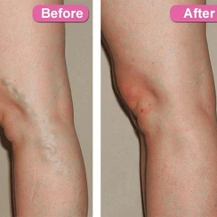 Varicose Veins Treatment Cream